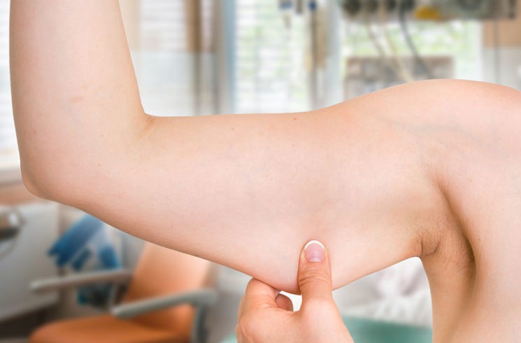 Everything You Need To Know About An Arm Lift Surgery!