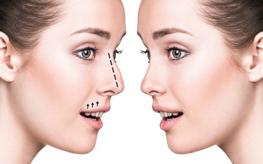 Two Sides Of Rhinoplasty Surgery (Nose Job)
