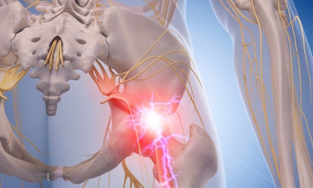 9 Treatment Options that Work for Sciatica Pain
